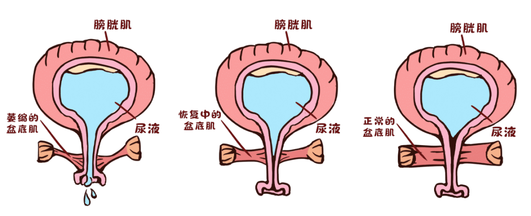 告别尴尬，重获掌控：盆底肌锻炼全攻略与“窍门”妙用 百事百科